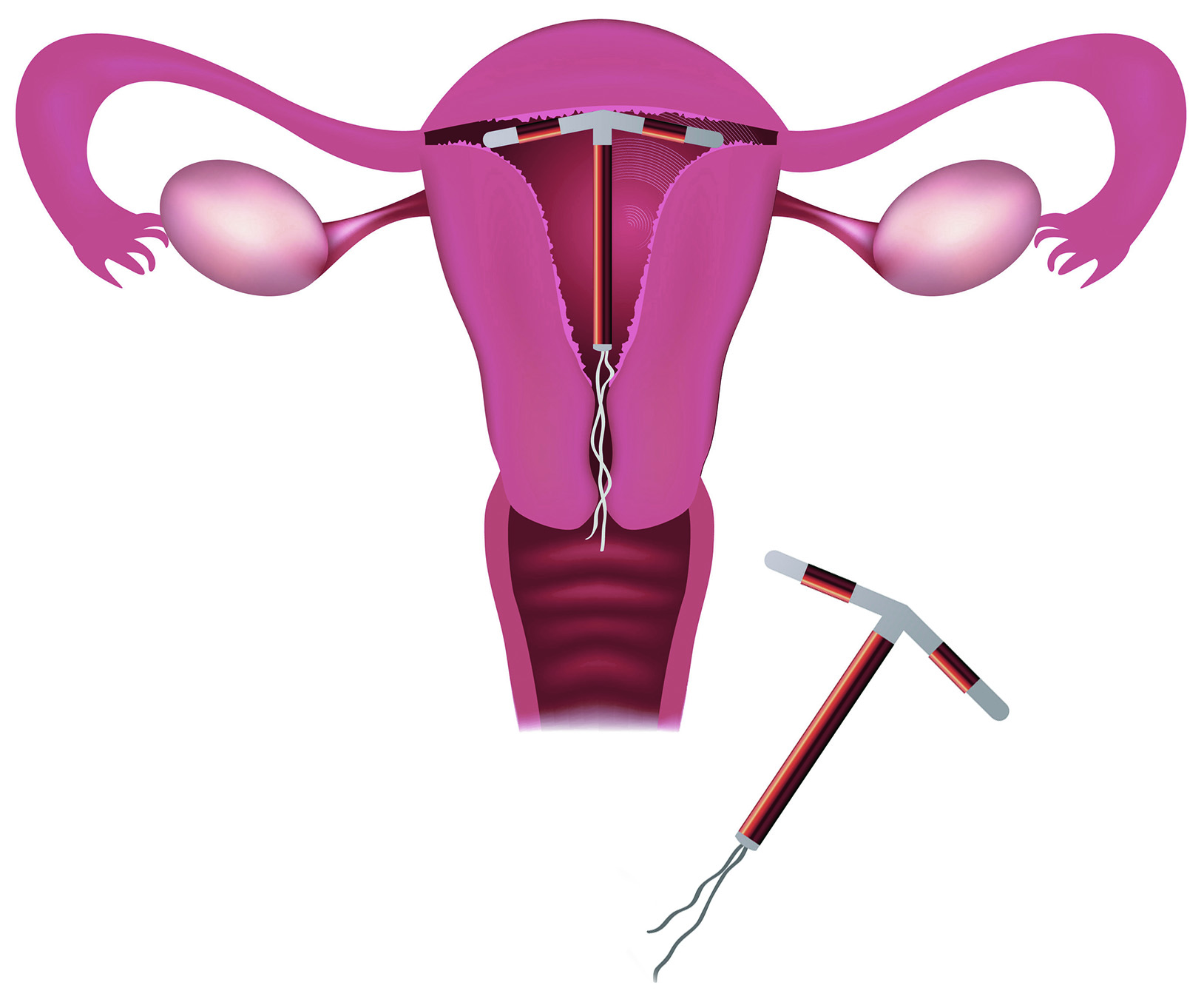 iud insertion